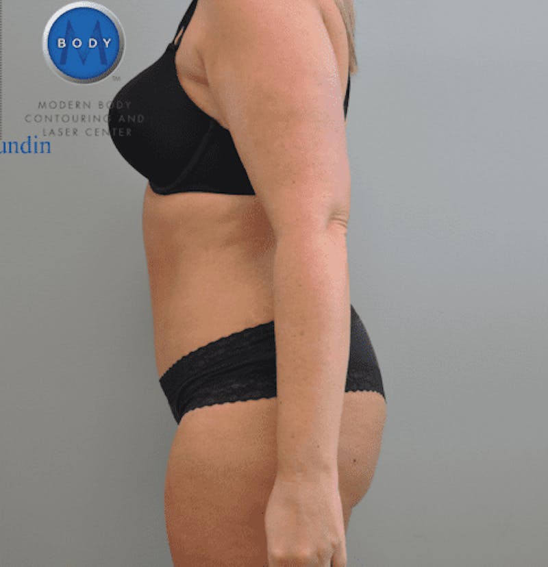 Tummy Tuck Before & After Gallery - Patient 55345309 - Image 4