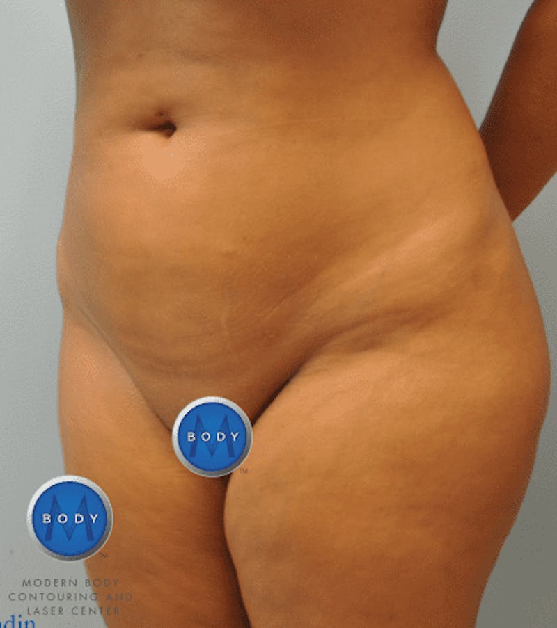 Brazilian Butt Lift Gallery - Patient 55345310 - Image 14