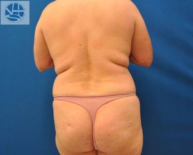 Liposuction Before & After Gallery - Patient 55345313 - Image 5
