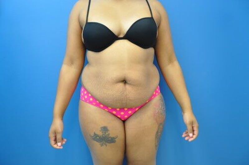 Tummy Tuck Before & After Gallery - Patient 55345314 - Image 1