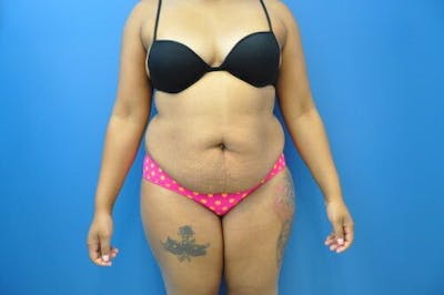 Tummy Tuck Before & After Gallery - Patient 55345314 - Image 1