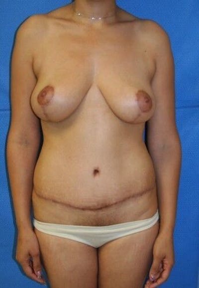 Mommy Makeover Gallery - Patient 55345312 - Image 2