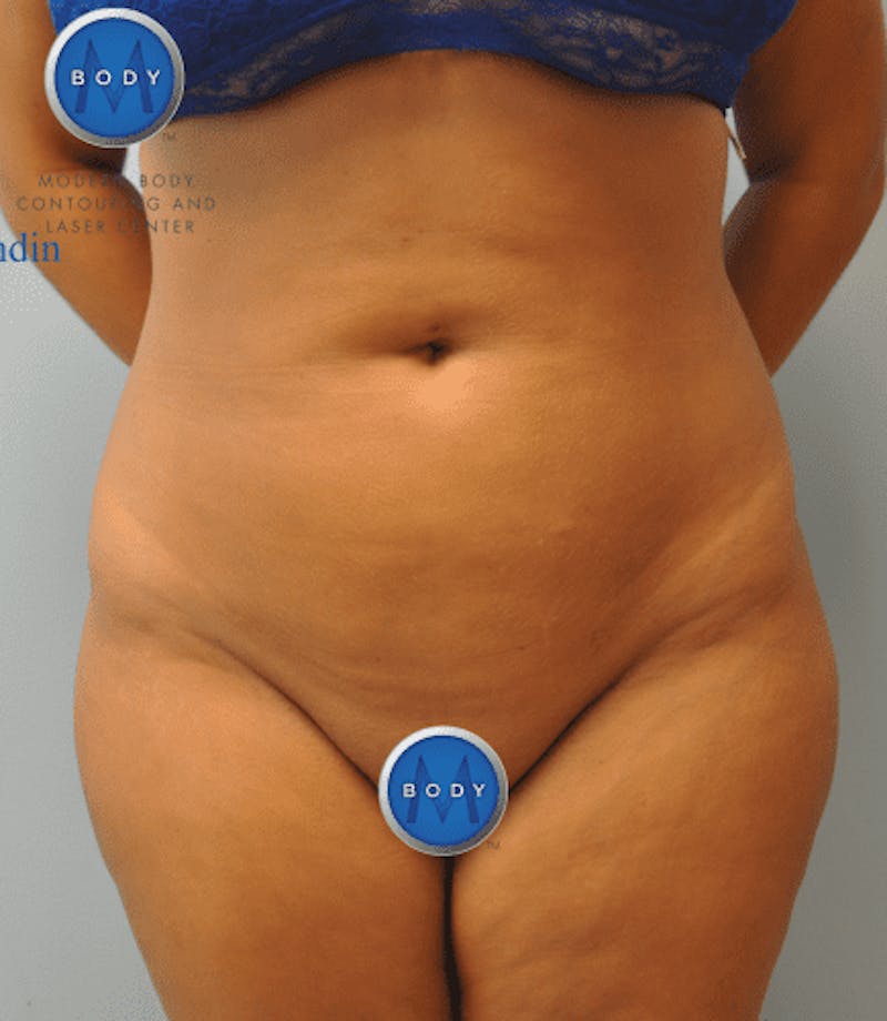 Brazilian Butt Lift Before & After Gallery - Patient 55345310 - Image 16
