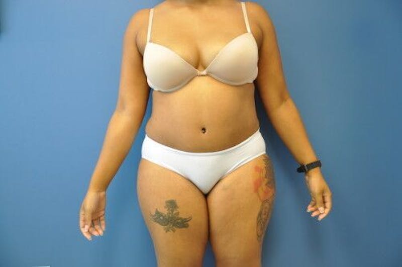 Tummy Tuck Before & After Gallery - Patient 55345314 - Image 2