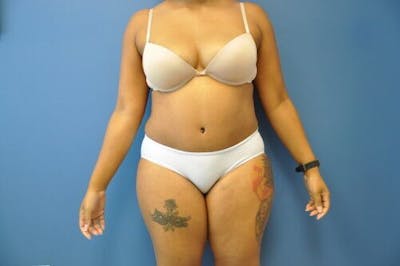 Tummy Tuck Gallery - Patient 55345314 - Image 2