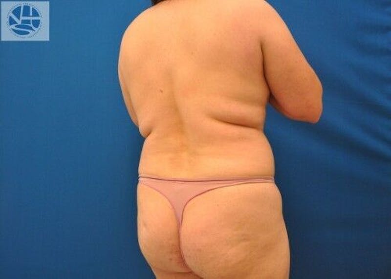 Liposuction Before & After Gallery - Patient 211876597 - Image 7