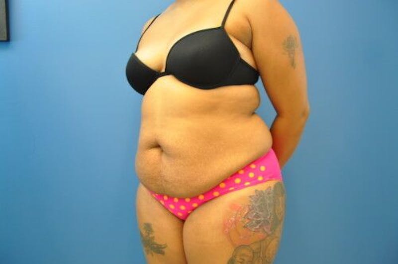 Tummy Tuck Before & After Gallery - Patient 55345314 - Image 3