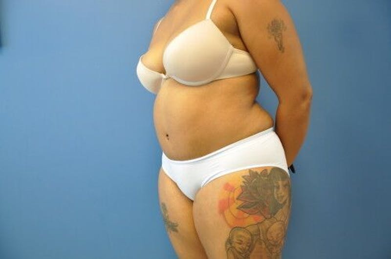 Tummy Tuck Before & After Gallery - Patient 55345314 - Image 4