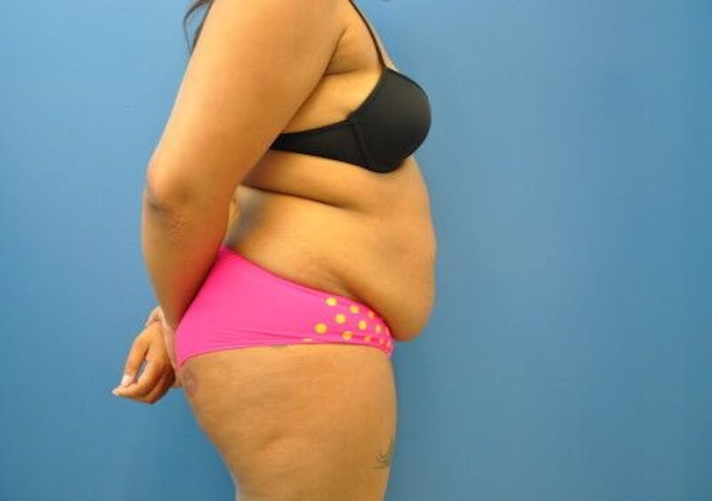 Tummy Tuck Before & After Gallery - Patient 55345314 - Image 5
