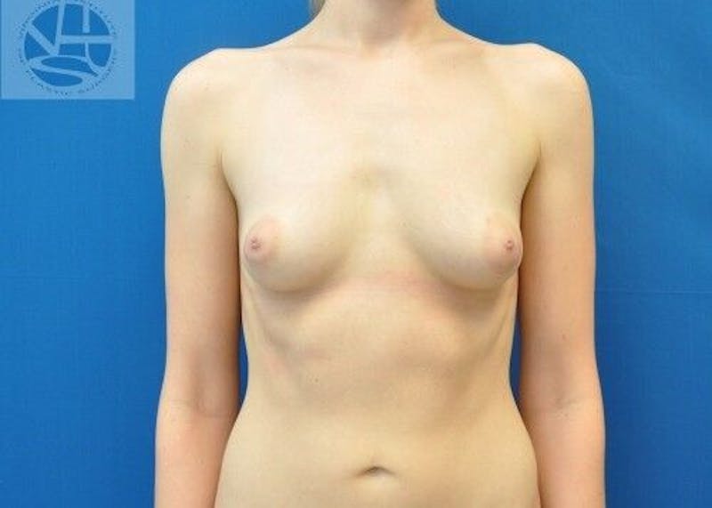 Breast Augmentation Before & After Gallery - Patient 55345316 - Image 1