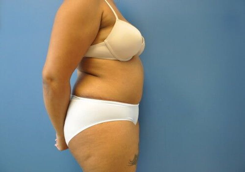 Tummy Tuck Before & After Gallery - Patient 55345314 - Image 6
