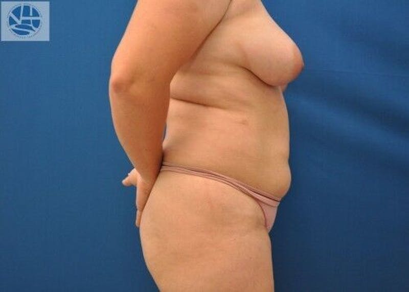 Liposuction Before & After Gallery - Patient 55345313 - Image 11