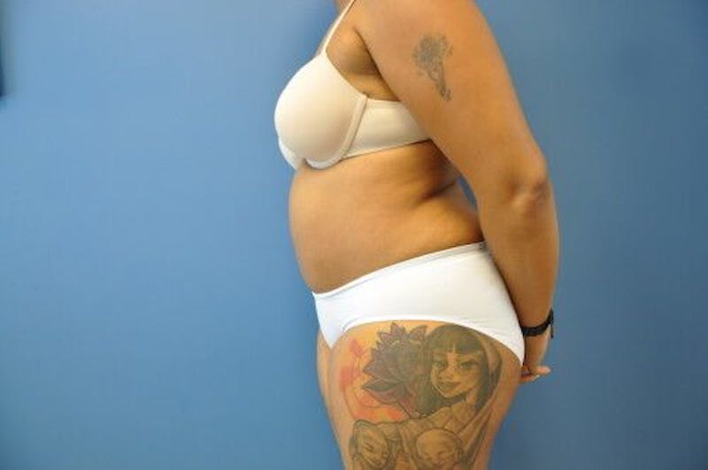 Tummy Tuck Before & After Gallery - Patient 55345314 - Image 8