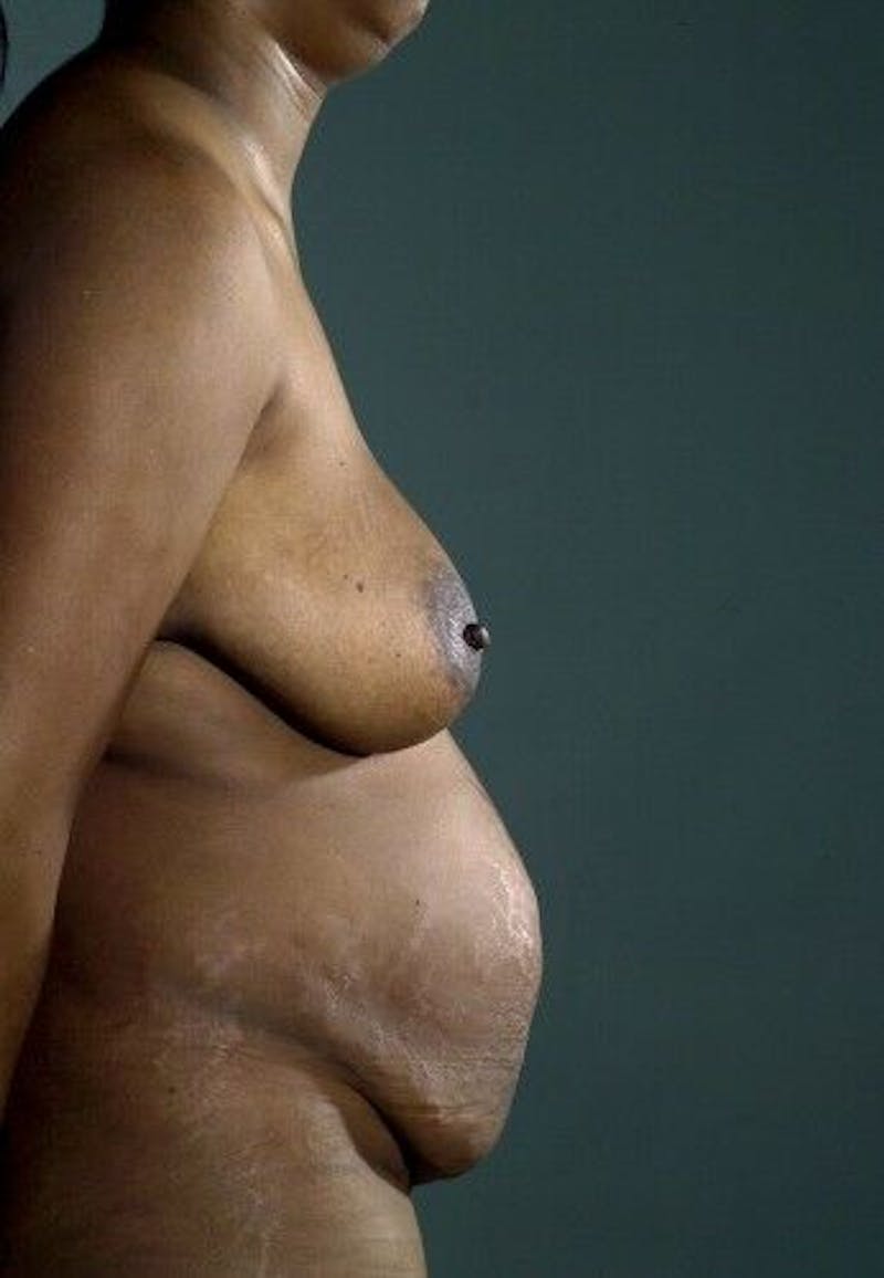 Mommy Makeover Before & After Gallery - Patient 55345317 - Image 5