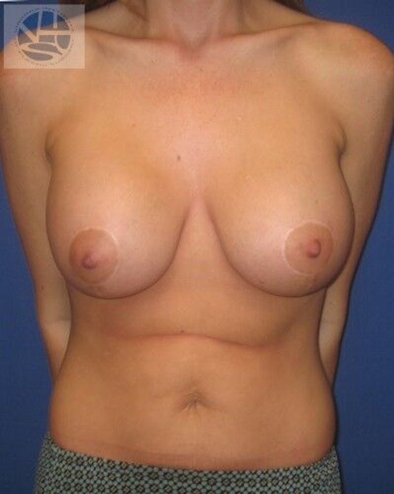 Breast Augmentation Before & After Gallery - Patient 55345321 - Image 2