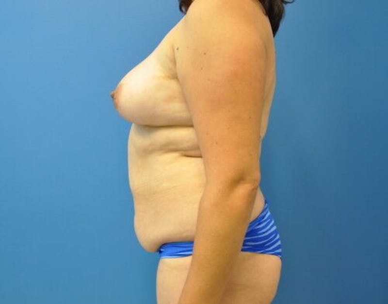Plus Size Tummy Tuck Before & After Gallery - Patient 265249 - Image 3