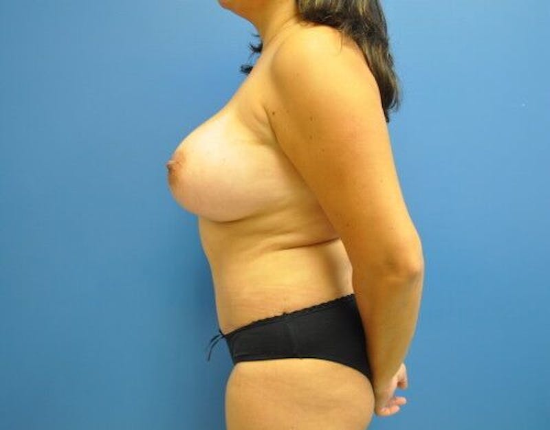 Plus Size Tummy Tuck Before & After Gallery - Patient 265249 - Image 4
