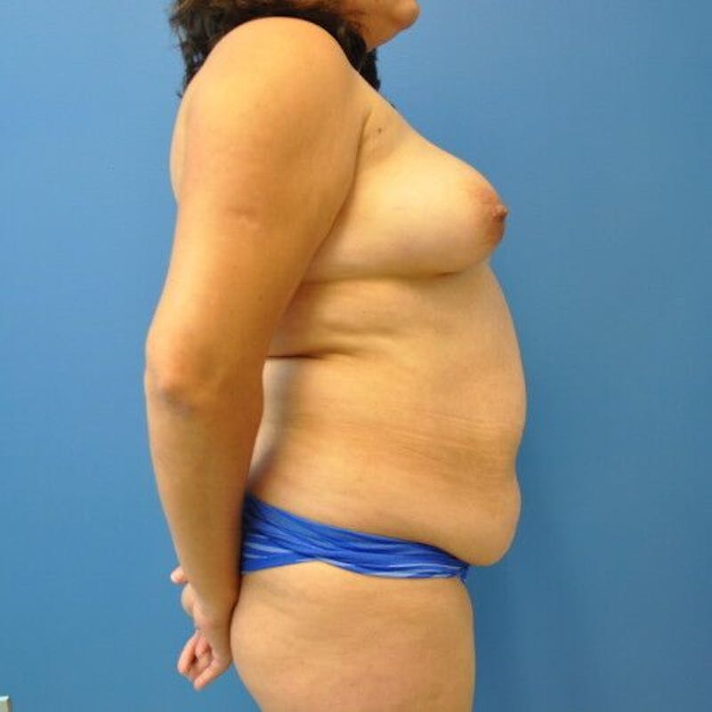 Plus Size Tummy Tuck Before & After Gallery - Patient 265249 - Image 5