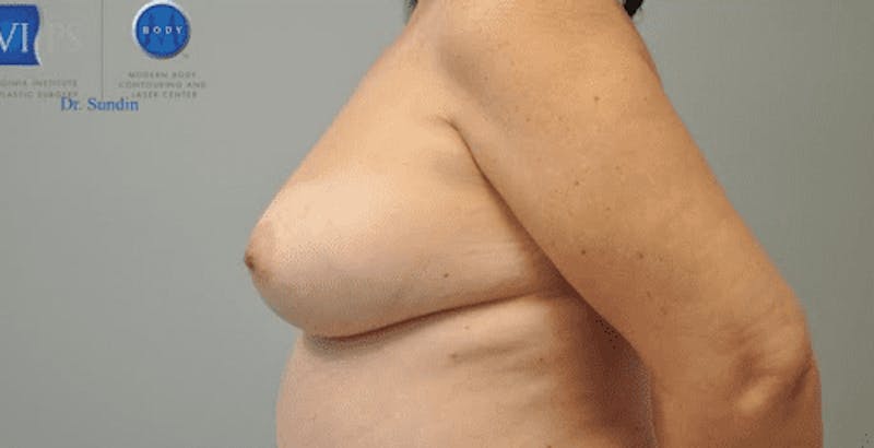 Breast Augmentation with Fat Grafting Before & After Gallery - Patient 55345319 - Image 6