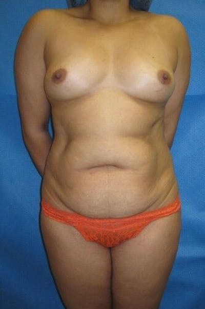 Liposuction Gallery - Patient 55345328 - Image 1