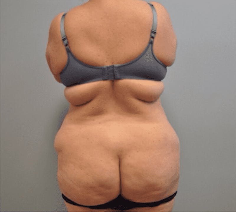 Plus Size Tummy Tuck Before & After Gallery - Patient 373437 - Image 3