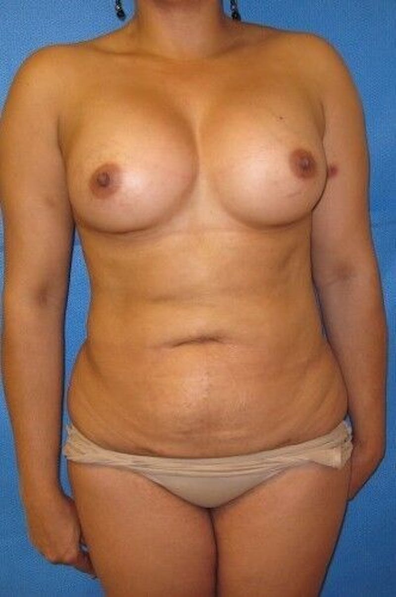 Liposuction Before & After Gallery - Patient 55345328 - Image 2
