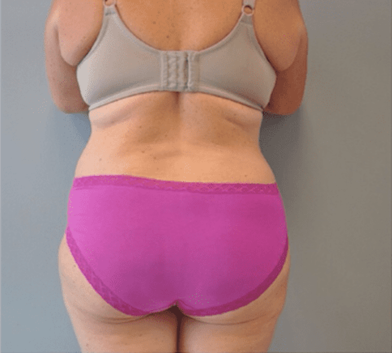 Plus Size Tummy Tuck Before & After Gallery - Patient 373437 - Image 4