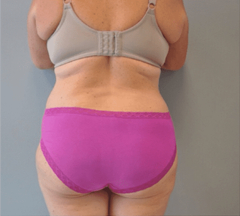 Extended Tummy Tuck Before & After Gallery - Patient 373437 - Image 4