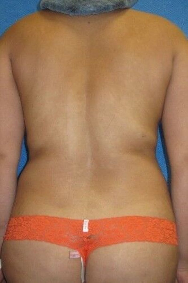 Liposuction Before & After Gallery - Patient 211876596 - Image 3
