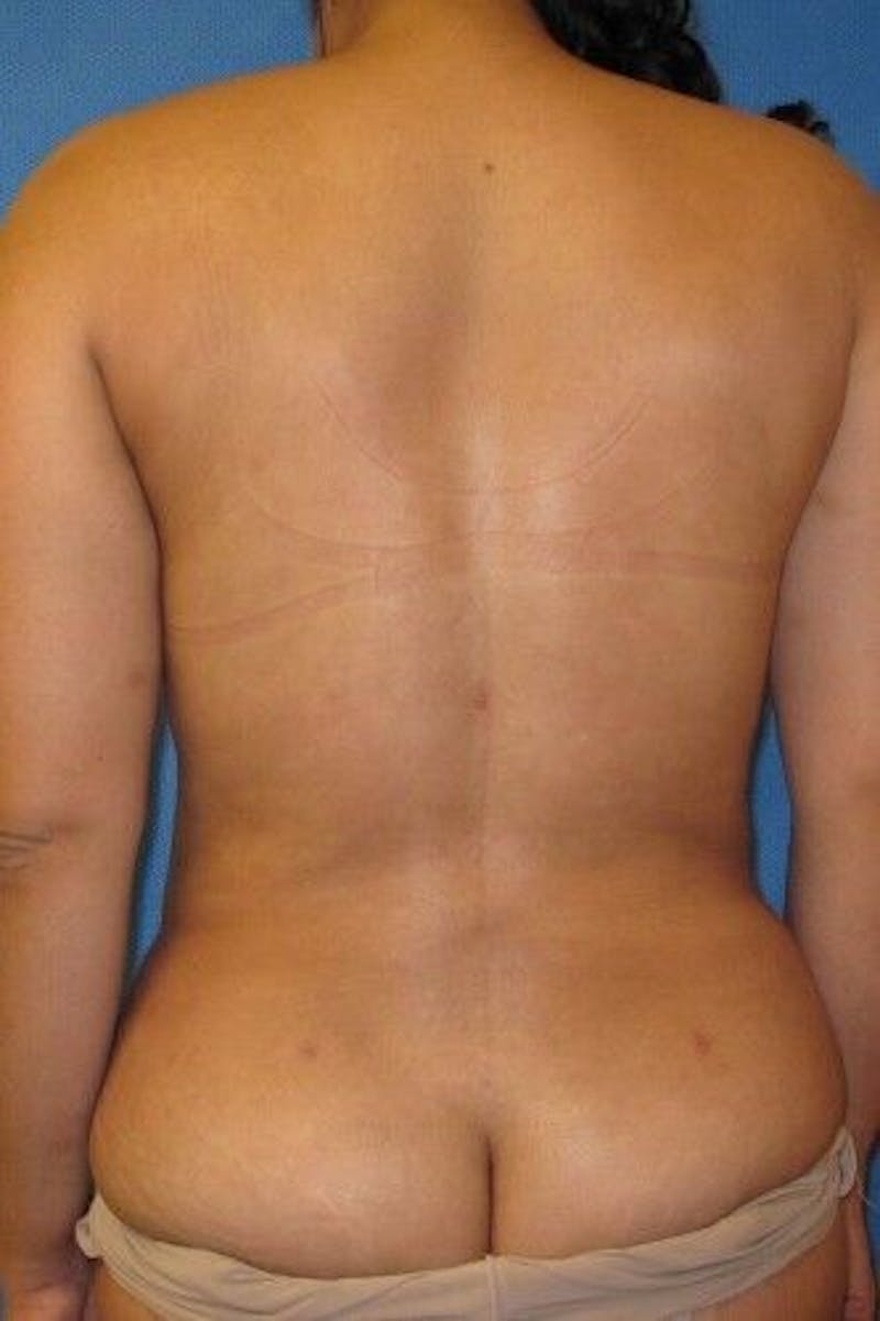 Liposuction Before & After Gallery - Patient 211876596 - Image 4