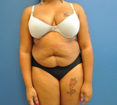 Tummy Tuck Before & After Gallery - Patient 55345326 - Image 1