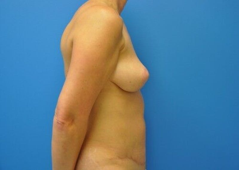Mommy Makeover Gallery - Patient 55345325 - Image 10