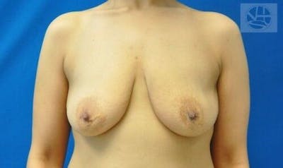 Breast Augmentation with Lift Before & After Gallery - Patient 55345332 - Image 1
