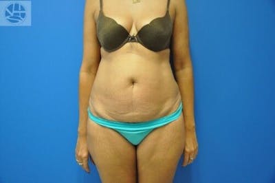 Tummy Tuck Before & After Gallery - Patient 55345333 - Image 1