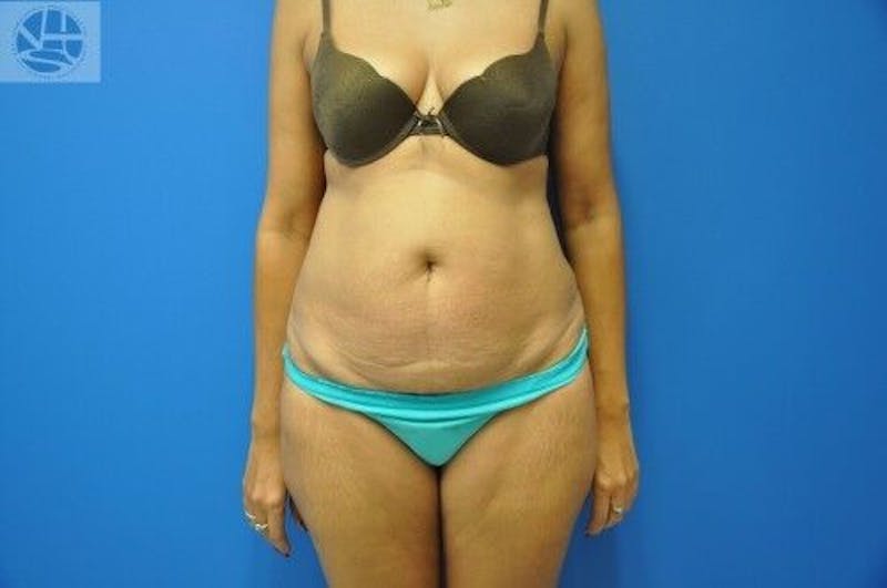 Tummy Tuck Before & After Gallery - Patient 55345333 - Image 1