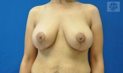 Breast Augmentation with Lift Before & After Gallery - Patient 55345332 - Image 2