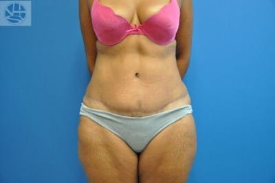 Tummy Tuck Before & After Gallery - Patient 55345333 - Image 2