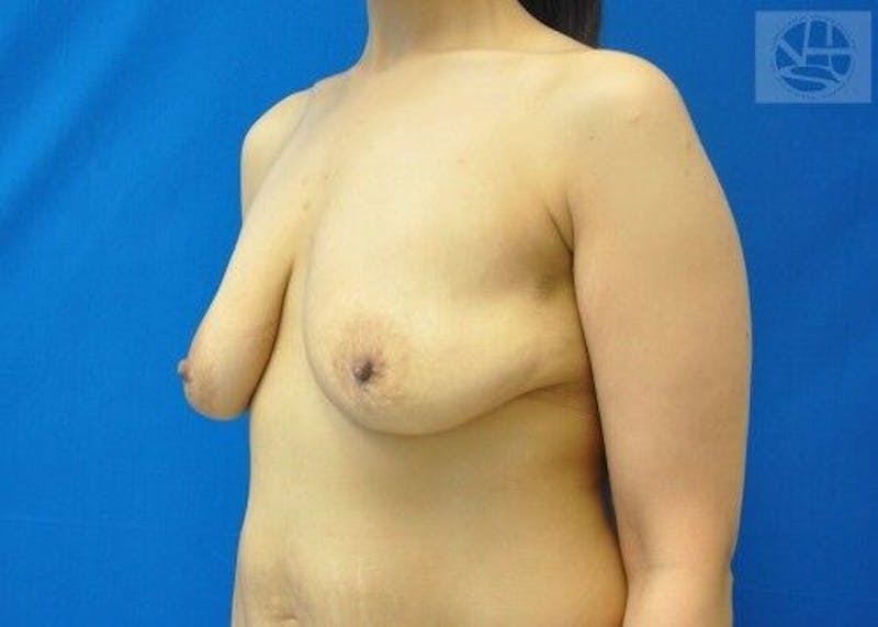 Breast Augmentation with Lift Gallery - Patient 55345332 - Image 3