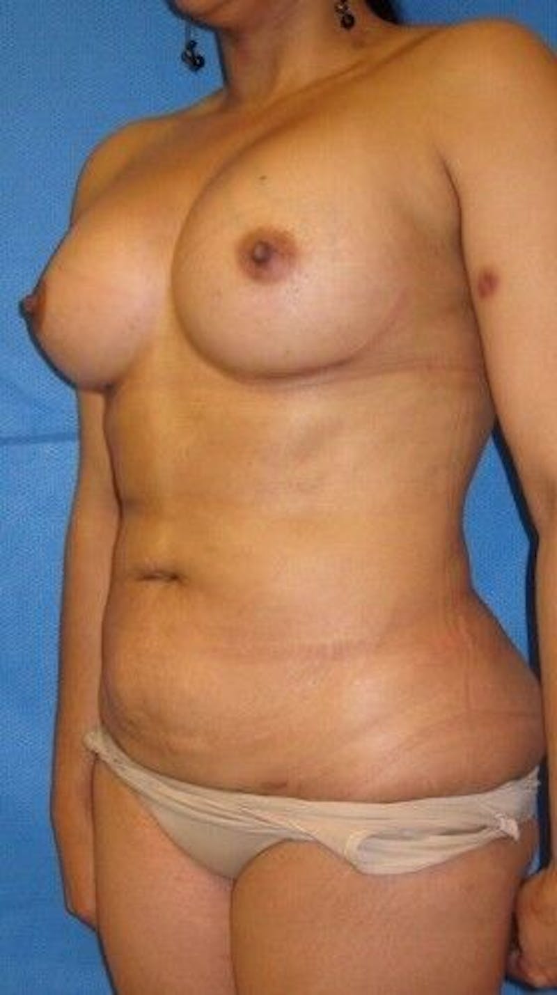 Liposuction Before & After Gallery - Patient 55345328 - Image 8
