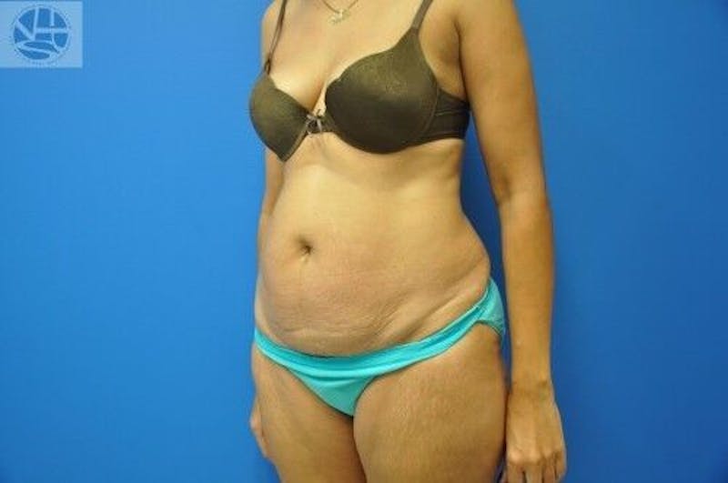 Tummy Tuck Before & After Gallery - Patient 55345333 - Image 3