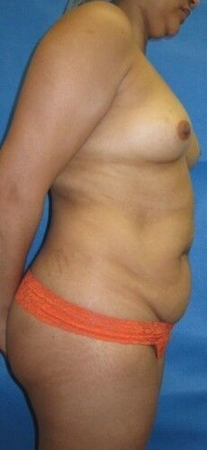 Liposuction Before & After Gallery - Patient 55345328 - Image 9