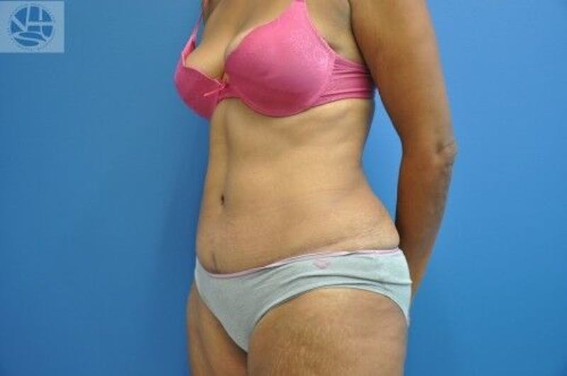 Tummy Tuck Before & After Gallery - Patient 55345333 - Image 4