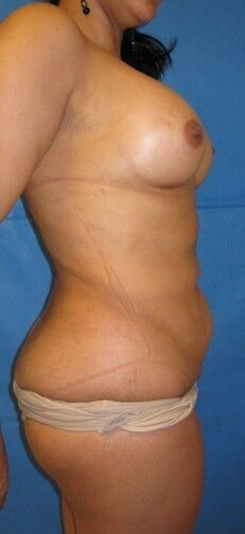 Liposuction Before & After Gallery - Patient 55345328 - Image 10