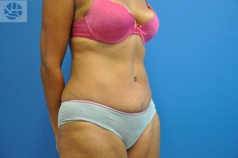 Tummy Tuck Before & After Gallery - Patient 55345333 - Image 5
