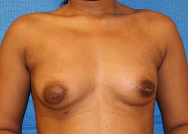 Liposuction Before & After Gallery - Patient 55345334 - Image 1