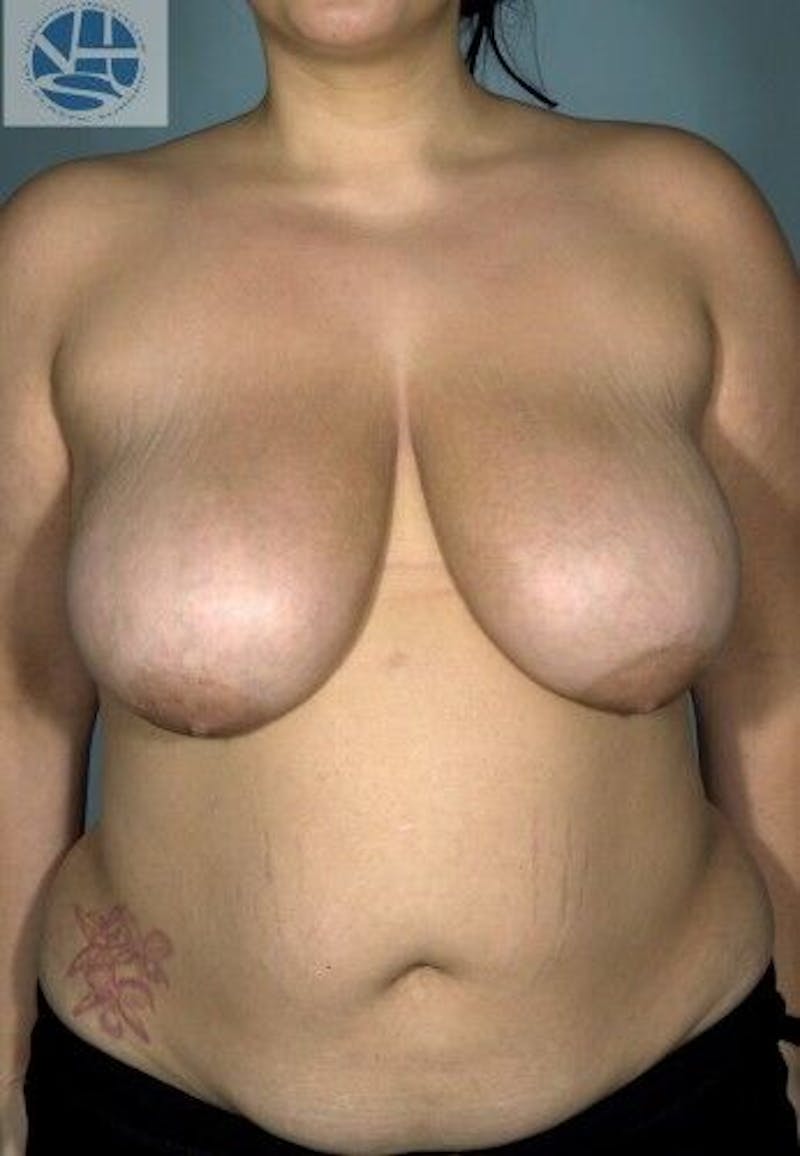 Breast Lift Before & After Gallery - Patient 55345336 - Image 1