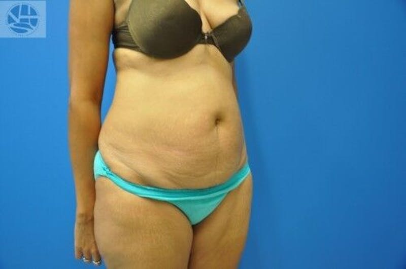 Tummy Tuck Before & After Gallery - Patient 55345333 - Image 6
