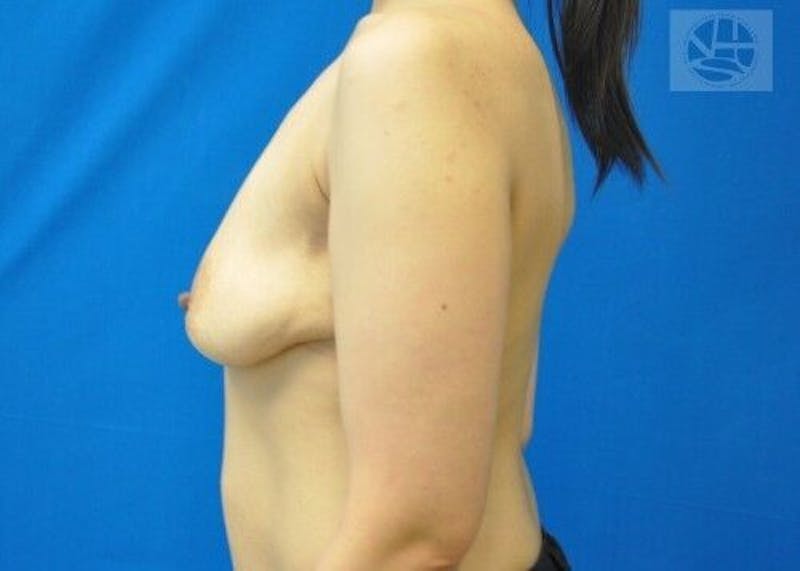 Breast Augmentation with Lift Before & After Gallery - Patient 55345332 - Image 7