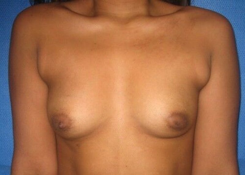 Liposuction Before & After Gallery - Patient 55345334 - Image 2