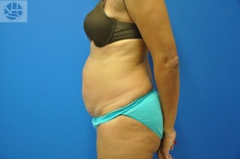 Tummy Tuck Before & After Gallery - Patient 55345333 - Image 7